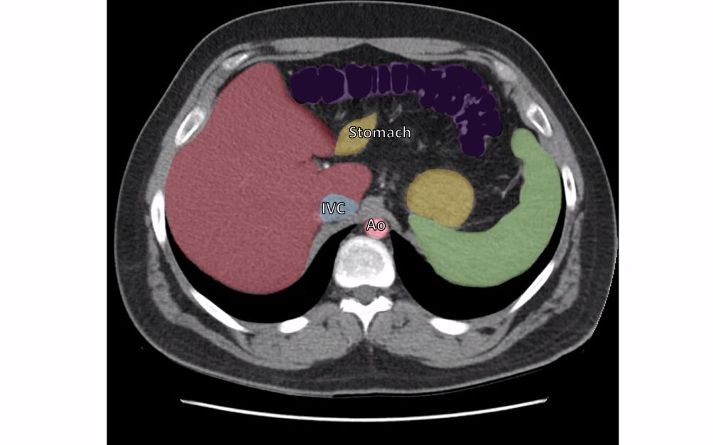 胸腔(the thorax)的横截面ct解剖