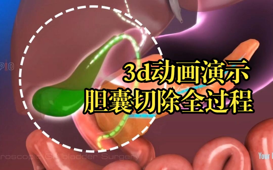 3d动画演示胆囊切除全过程哔哩哔哩bilibili