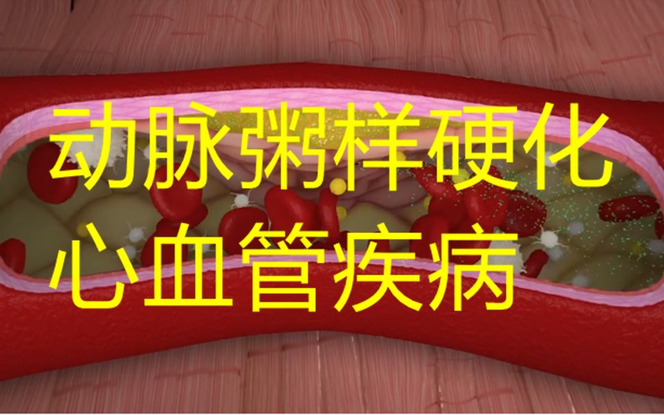 世界卫生组织将心血管疾病 (CVD) 列为全球第一大死因,估计每年夺去 1790 万人的生命.哔哩哔哩bilibili