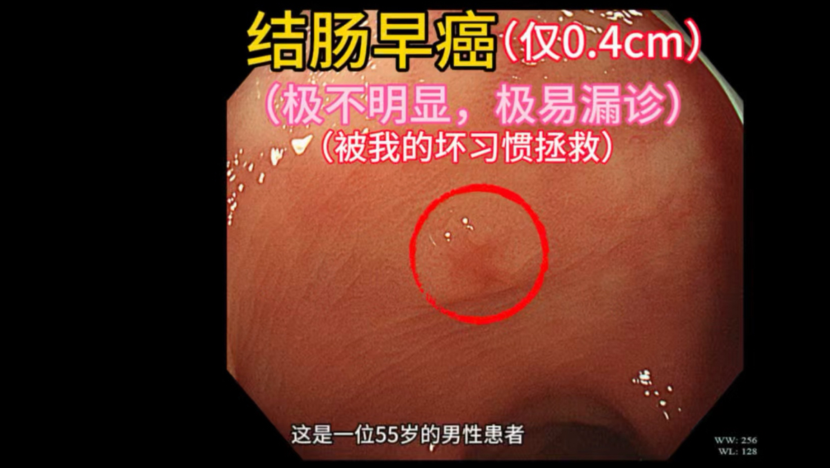 结肠早癌（仅0.4cm）：极不明显，极易漏诊！第一次都没有发现，但是被我的坏习惯拯救！！这是一位55岁男性患者，因腹胀伴大便习惯改变2月月行肠镜
