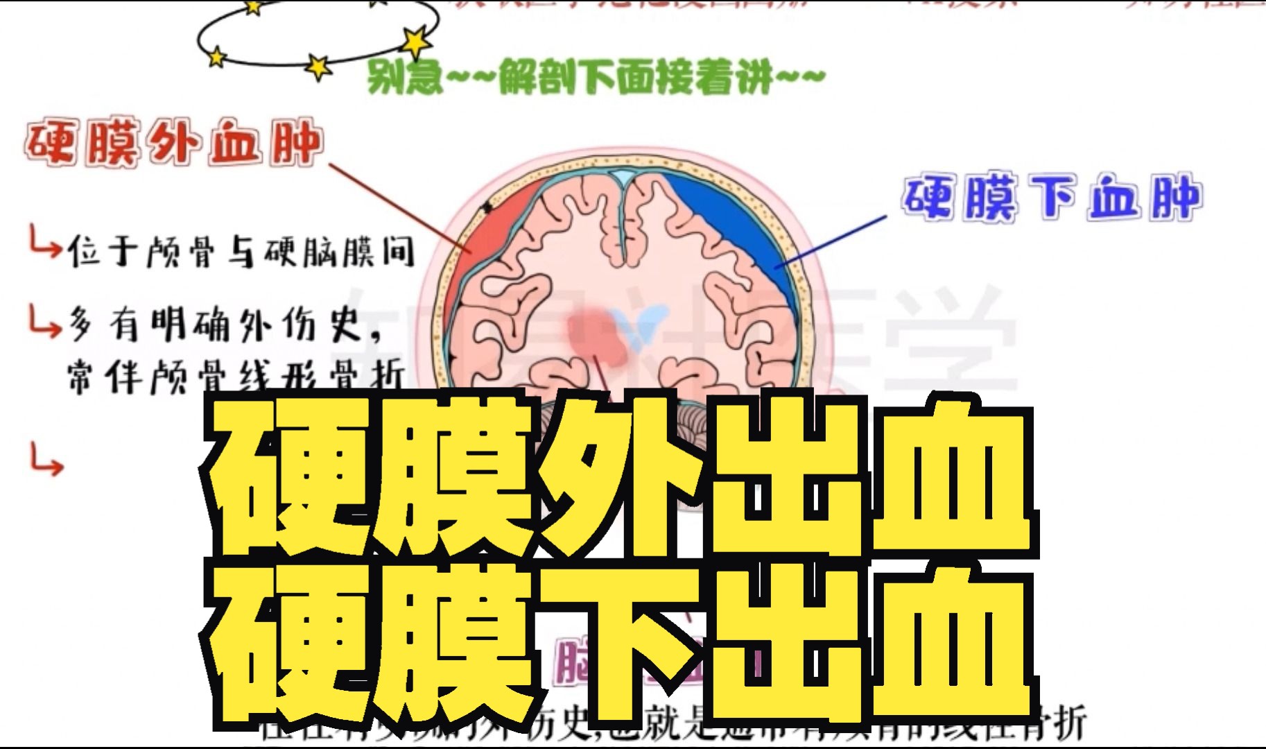 医学带背 硬膜下出血 vs 硬膜外出血 vs 脑内出血