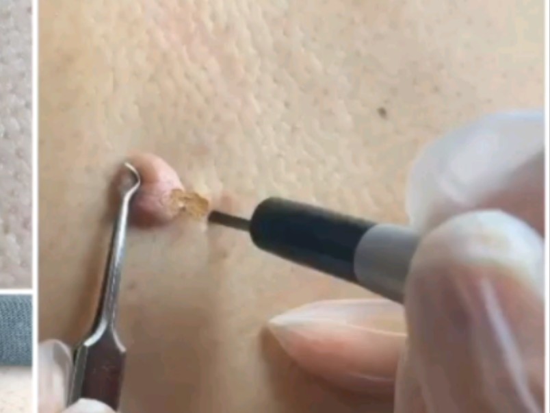 激光切除疣状痣,有类似的一定要看,不出血,不留疤的治疗方式