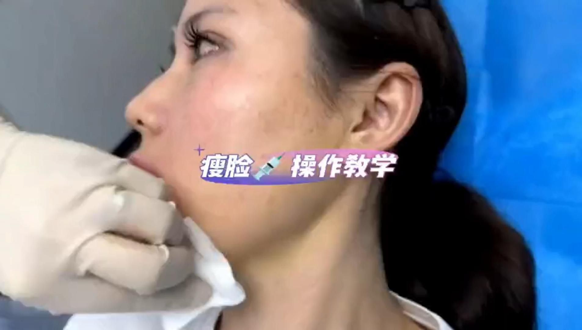 瘦脸针操作教学
