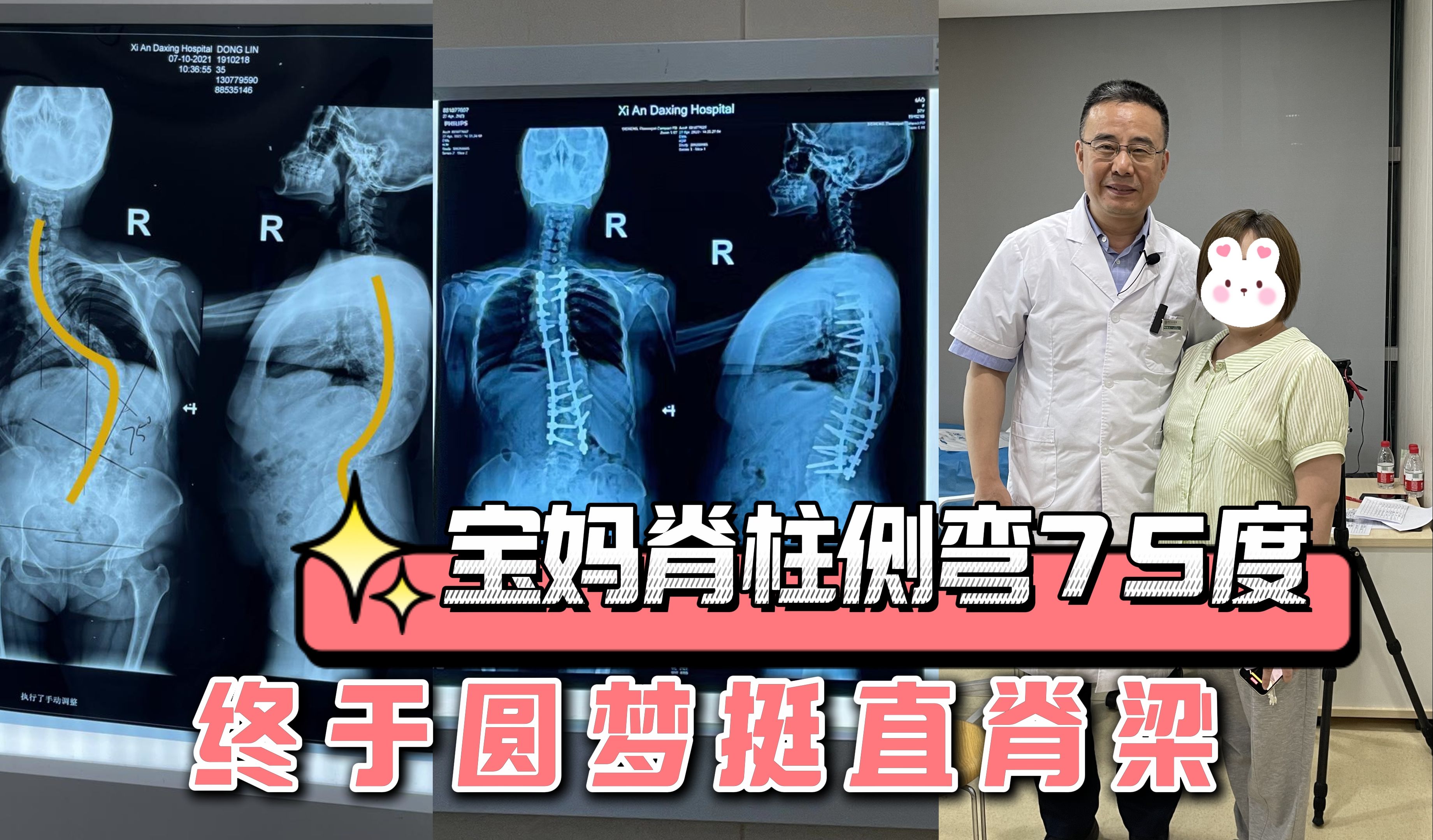 宝妈脊柱侧弯75度,背部不平24年,终获圆梦挺直脊梁