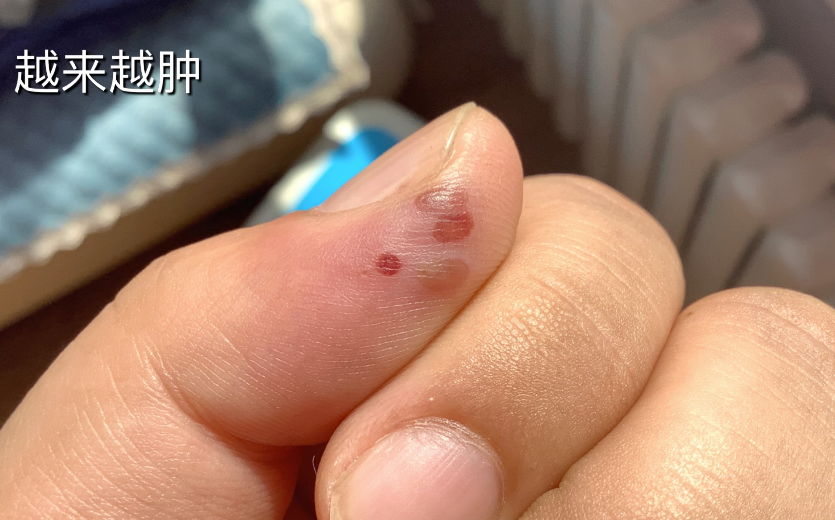 这是摄影莫名的手指内部感染痊愈过程