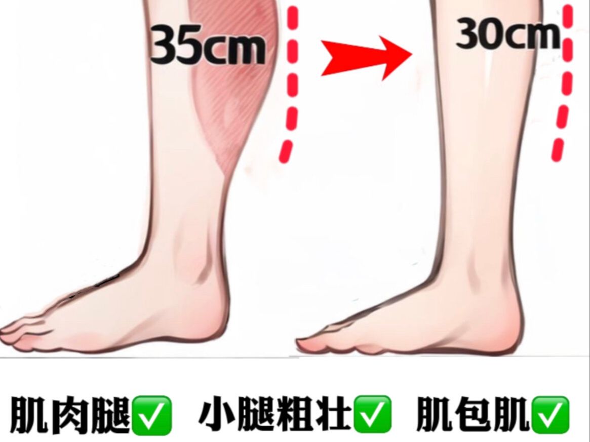 3招瘦小腿𐟔妐ž定小腿粗壮、肌肉腿、脂包哔哩哔哩bilibili