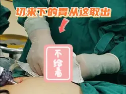 Download Video: 切下来的胃是怎么取出来的？