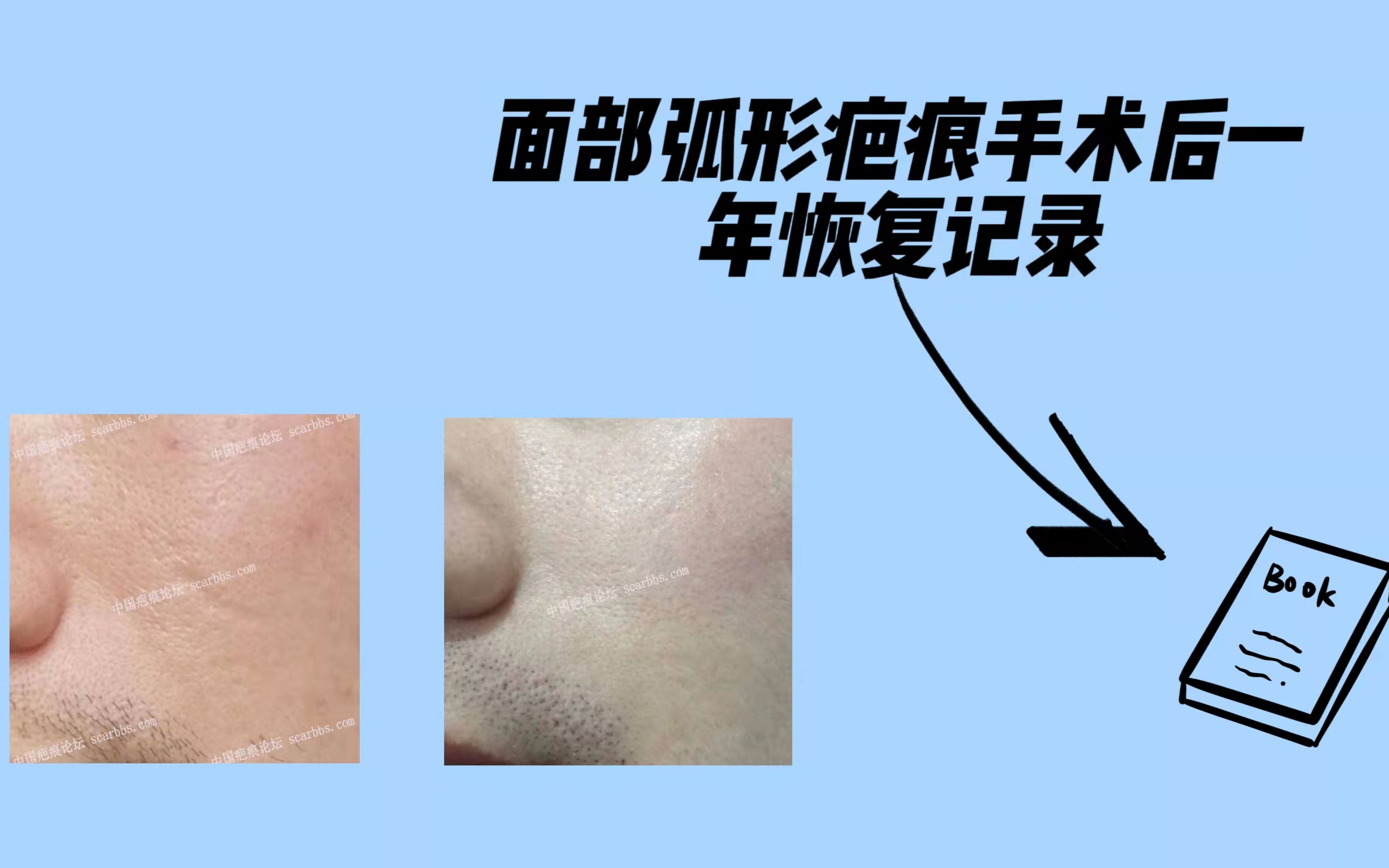 【阿国战疤第4期】面部弧形浅表性疤痕治疗效果