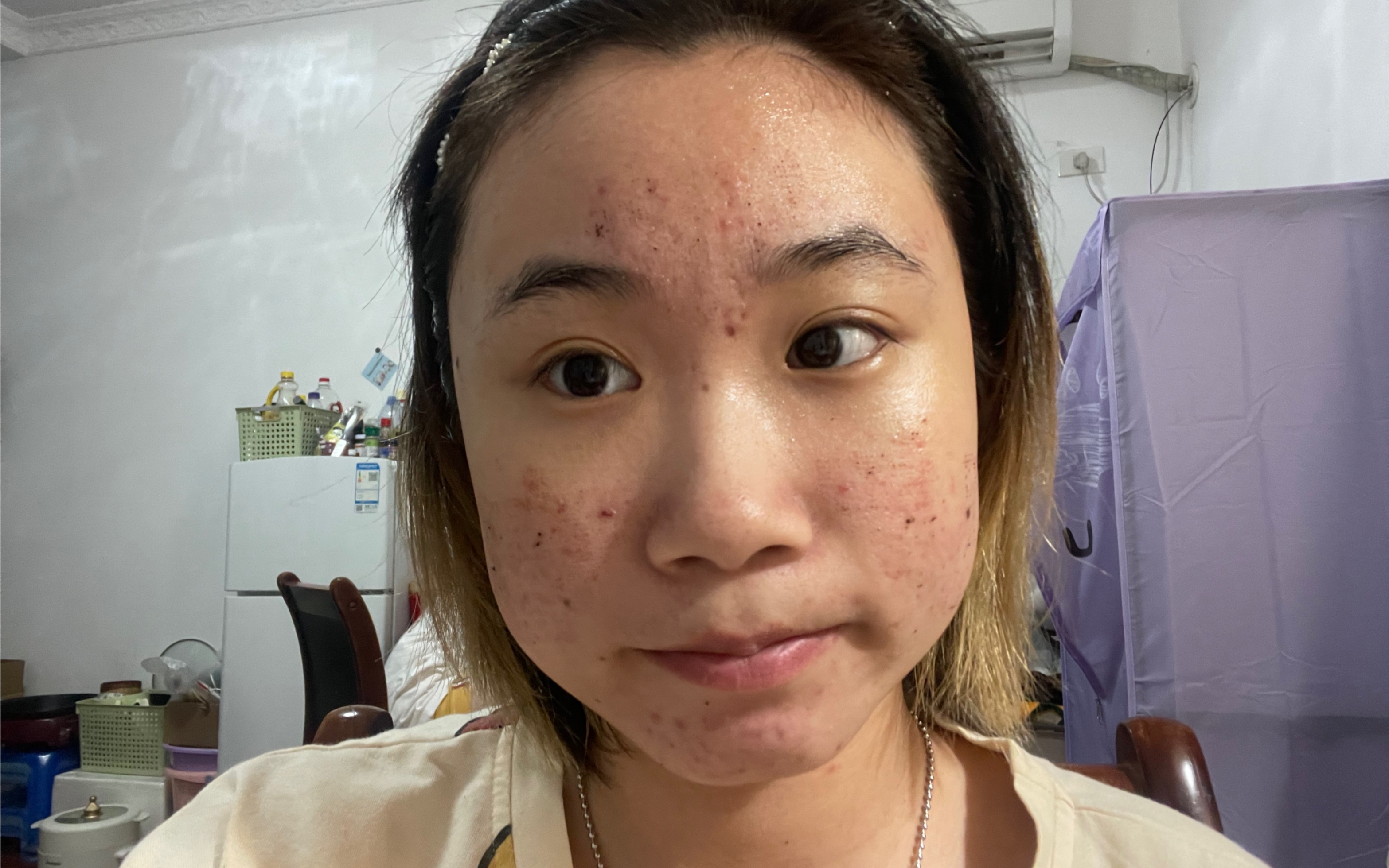 点阵激光术后第六天记录|血痂掉完了