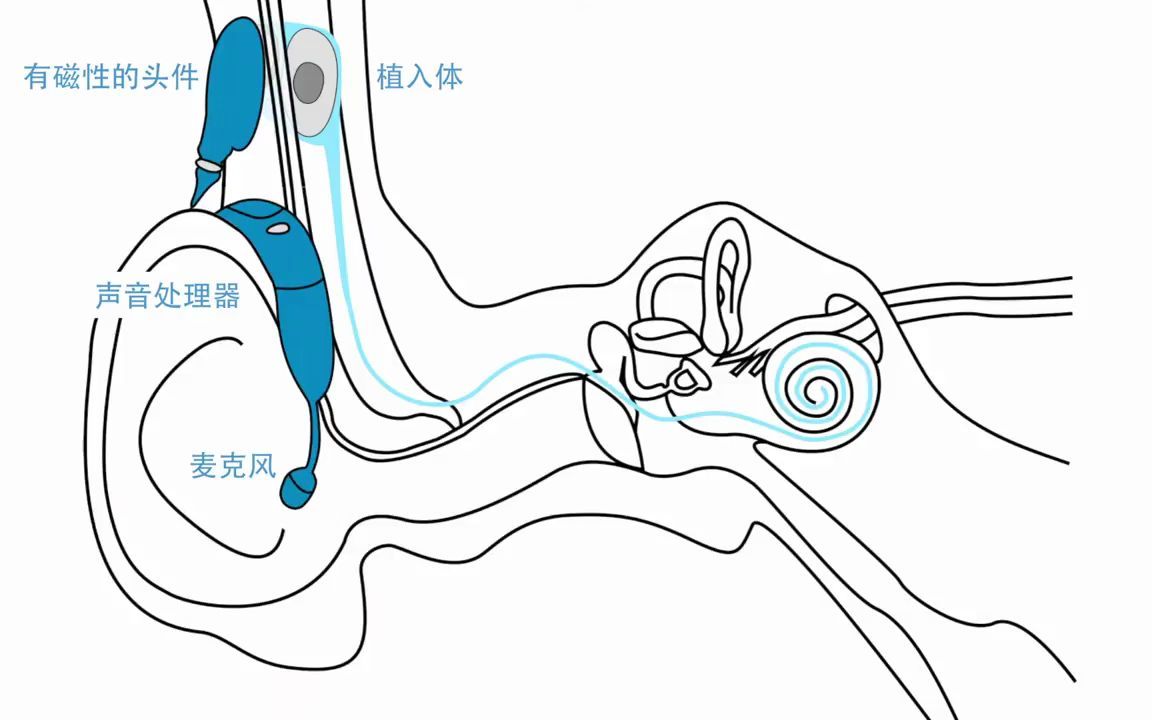 [图]人工耳蜗是如何工作的 [简体中文版]