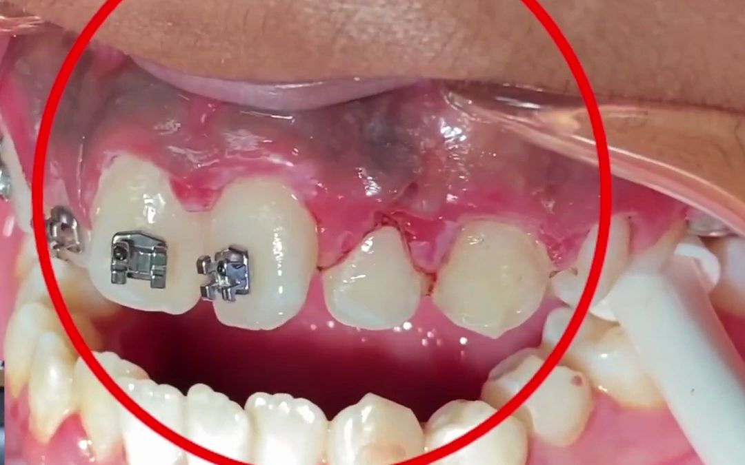 牙龈变黑的原因你知道吗?