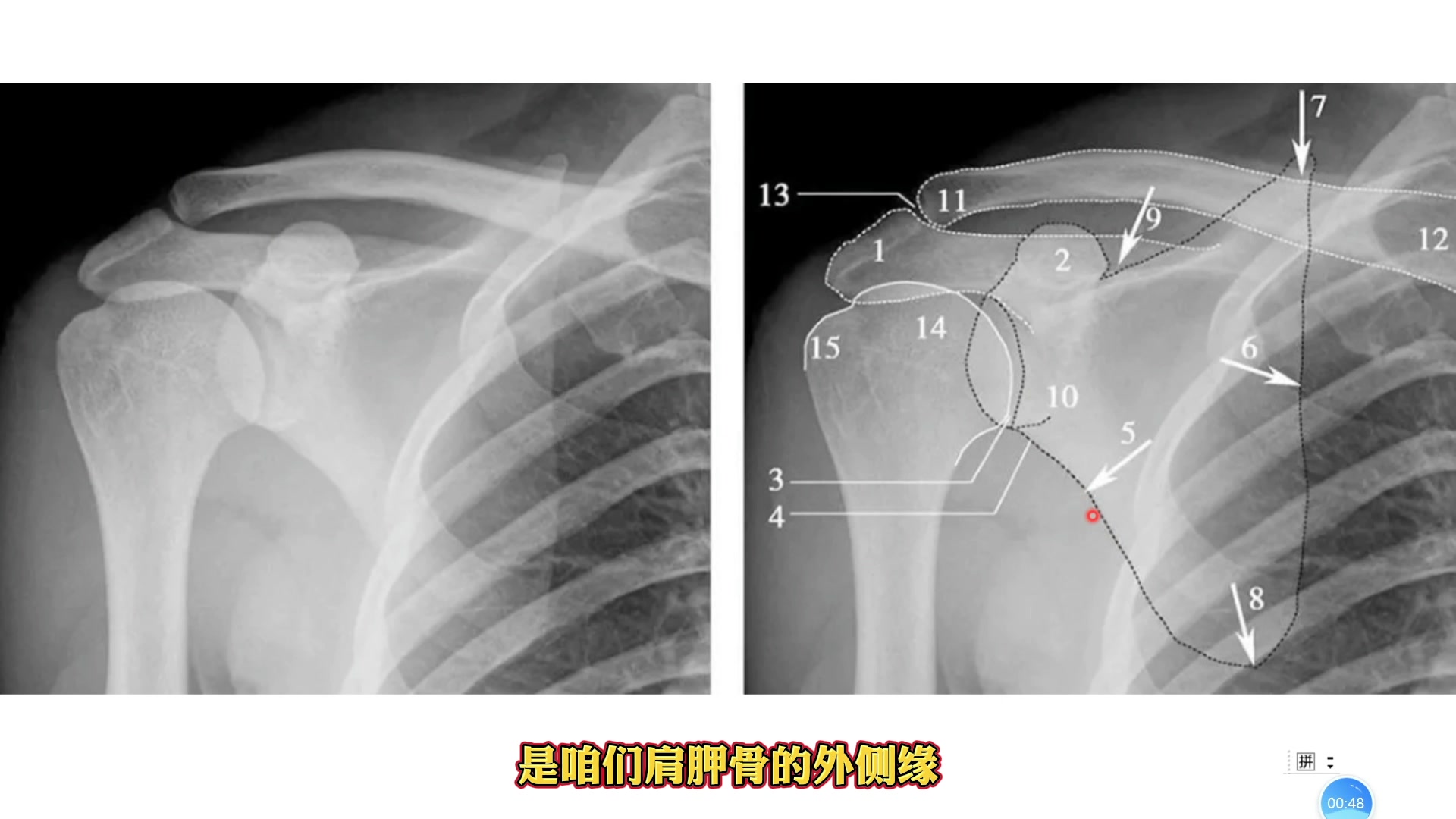 解剖回顾:肩关节x线解剖讲解,初学者收藏!