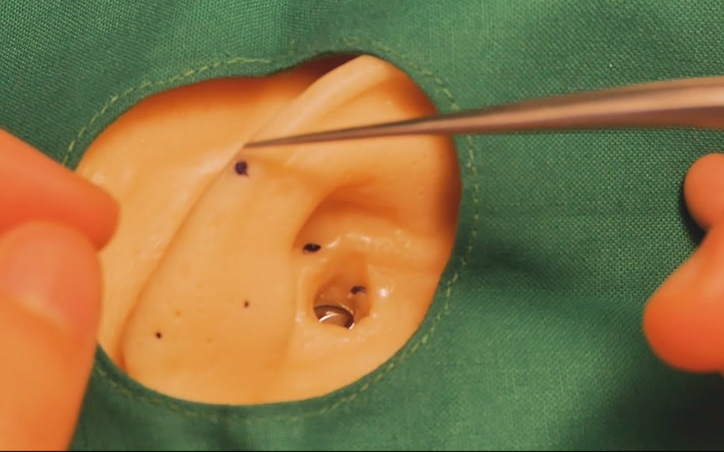 【asmr】去除耳部结石(视听享受)|耳鼻喉科73vol.74