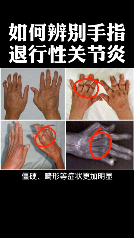 看了这个视频风湿骨病类风湿关节