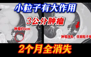 Descargar video: 肿瘤内部植入小粒子，两个月全消失！83岁肺腺癌如今四年未复发