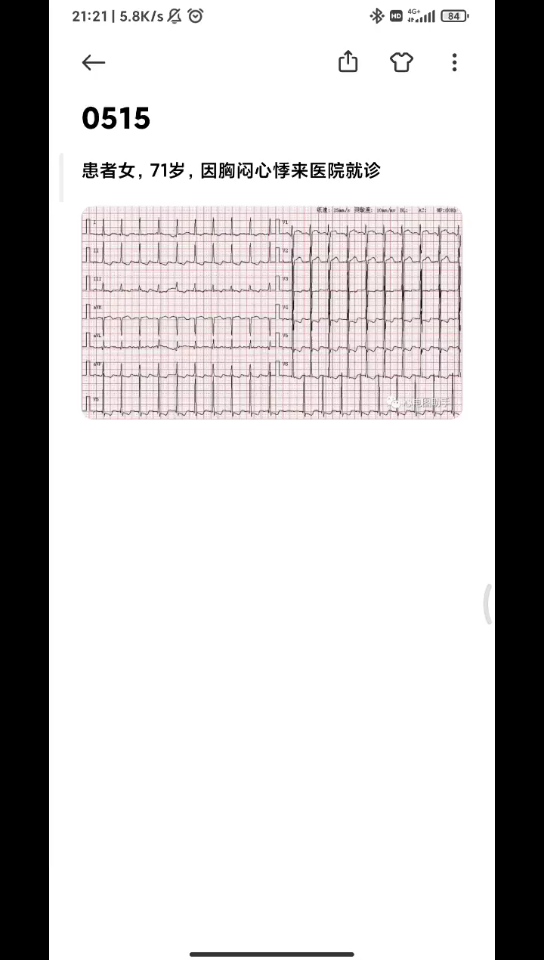 0515每天一份心电图,心房扑动哔哩哔哩bilibili