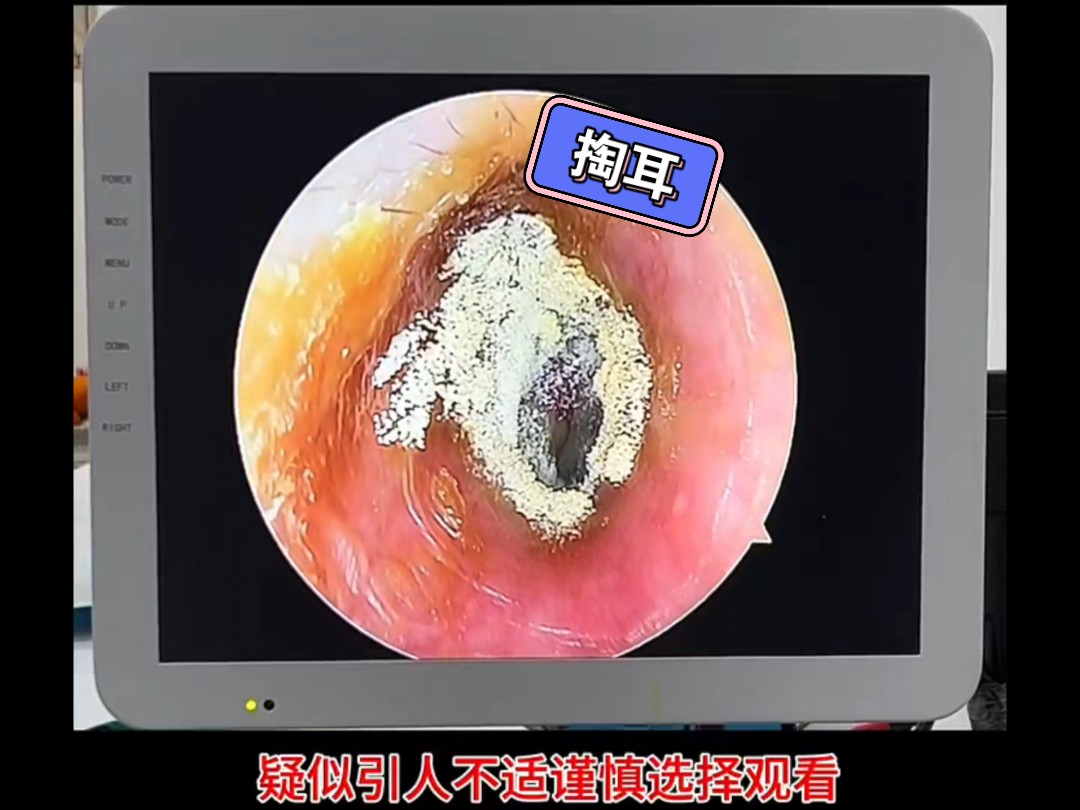 耳朵里面上霉了,真是遭老罪了