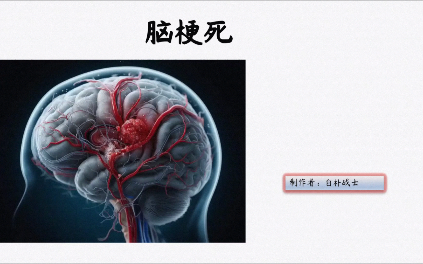 PPT讲解——脑梗死相关知识