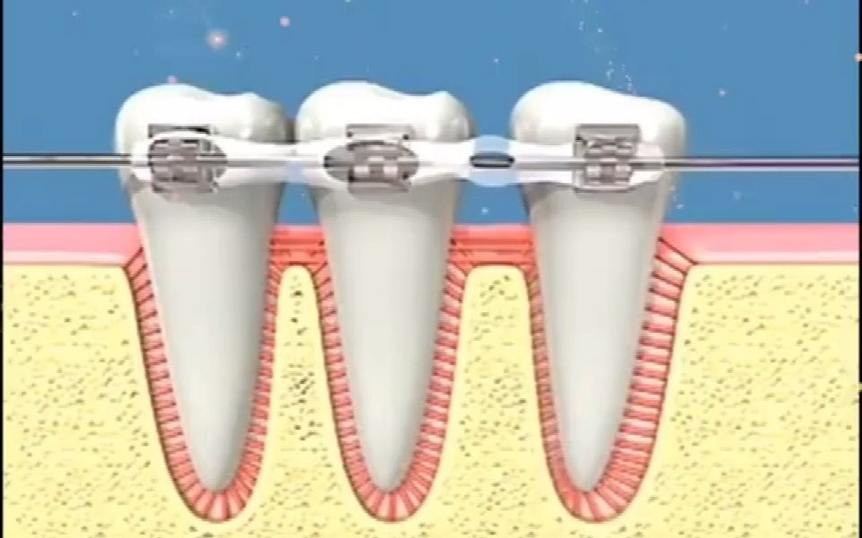 为啥牙齿矫正移动后还是健康的?哔哩哔哩bilibili