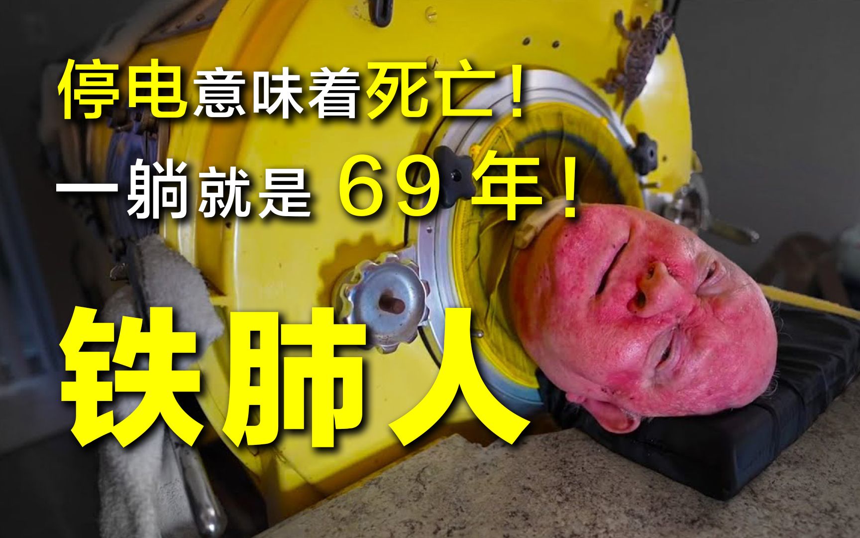 [图]【探谜】一生无法呼吸的铁肺人，被困“铁桶”69年，停电就意味着死亡降临