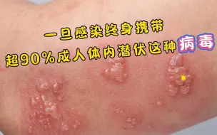 Download Video: 一旦感染终身携带！发作痛不欲生，超90%成人体内潜伏这种病毒