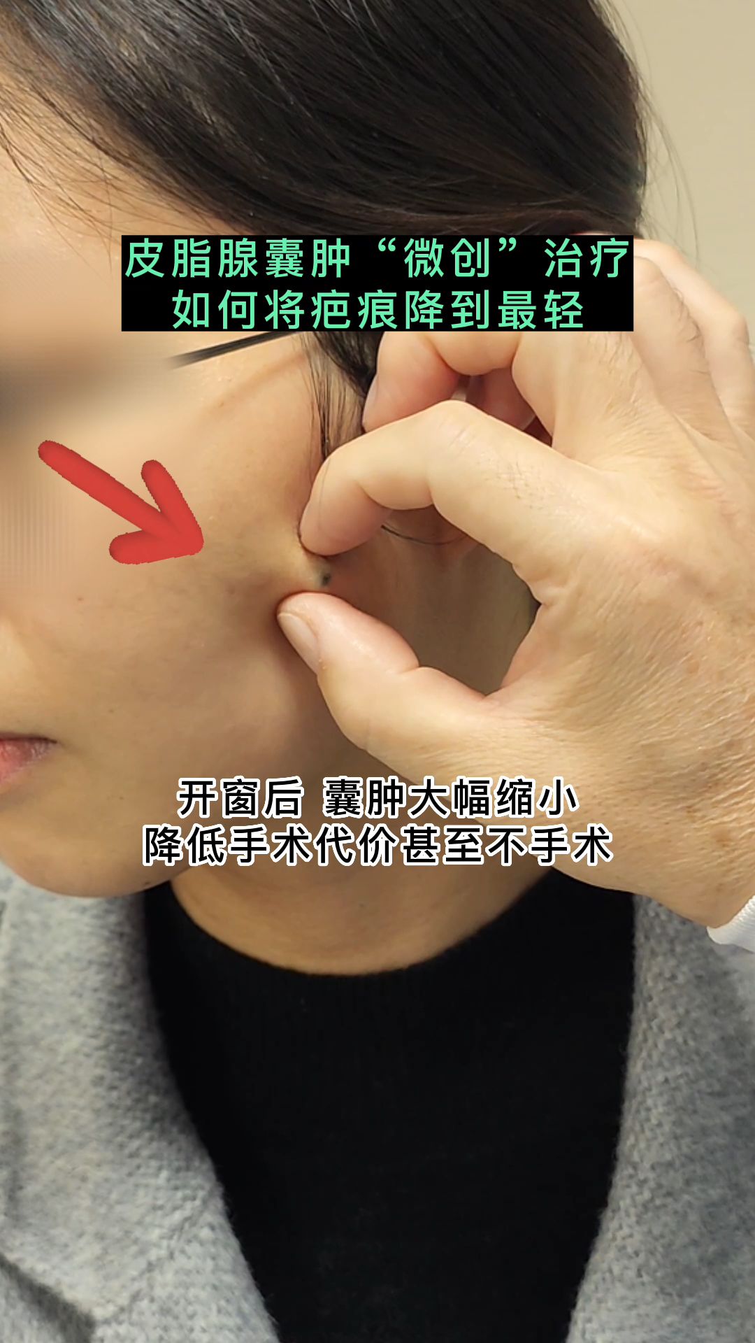 皮脂腺囊肿微创治疗:掌握核心科技,疤痕降到最低.
