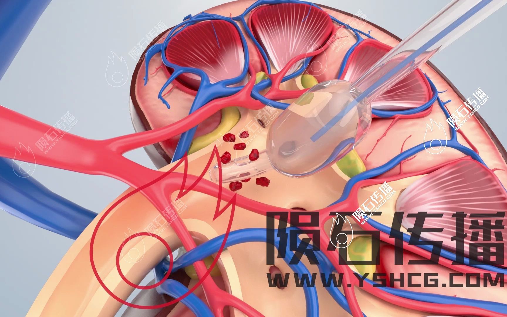 医疗3D动画演示医疗引流管手术哔哩哔哩bilibili