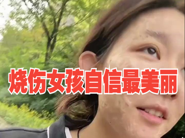 烧伤女孩微笑面对生活,"人本来就有很多种样子",网友:自信的女孩最棒!