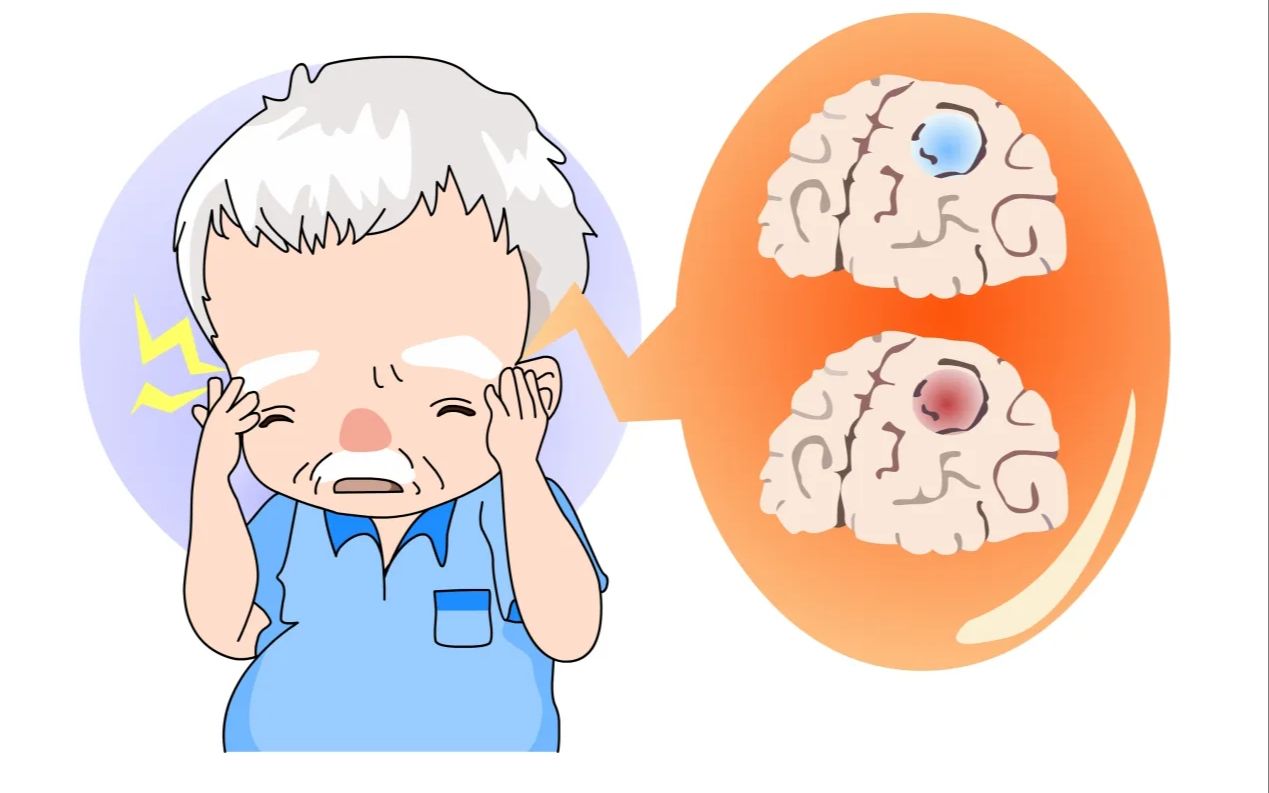 第六十九讲: 短暂性脑缺血