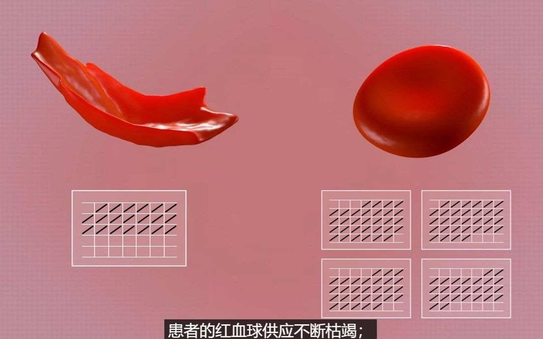镰形红细胞(高清版中文字幕)