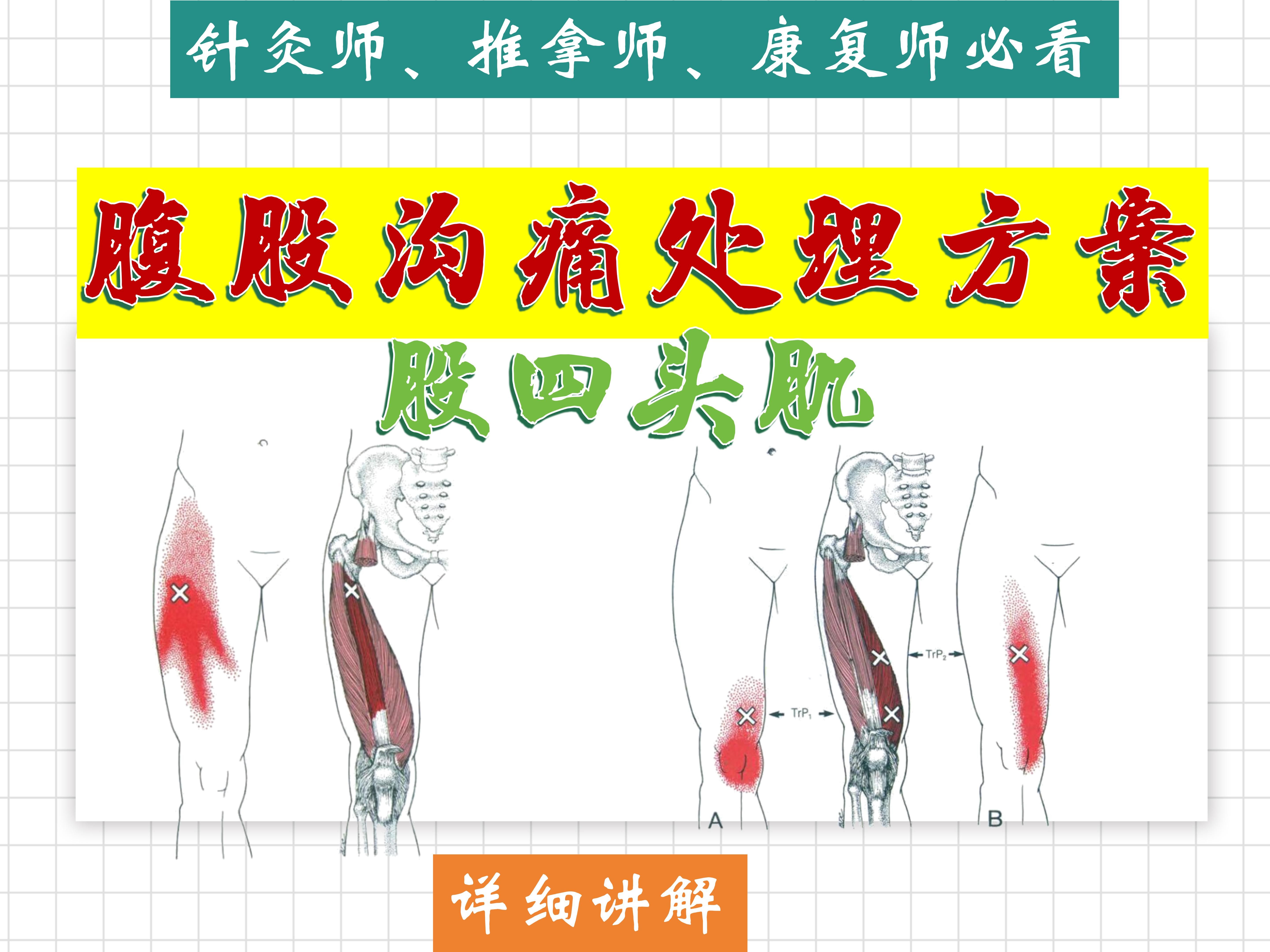 【腹股沟痛】的处理方案4涉及肌肉(股四头肌)详细讲解——位置、功能、激痛点、处理方法——天下明医平台简灵奇针哔哩哔哩bilibili