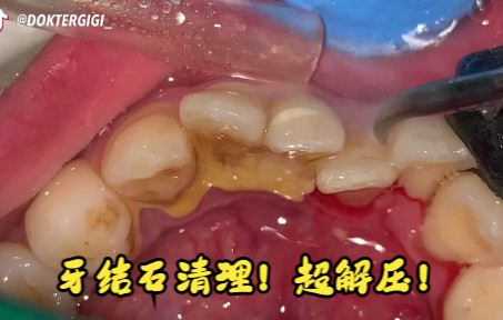 [图]【沉浸式洗牙】超解压的牙结石清理过程（2）！Dokter Gigi Tri Putra