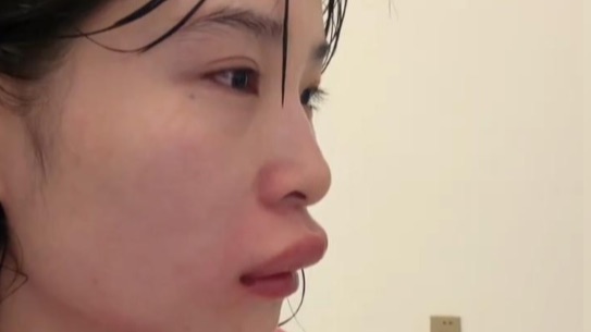 女子结婚头一天被马蜂蛰了，虽然很倒霉但真的有点好笑，网友：一天过去了，你咋结的婚？