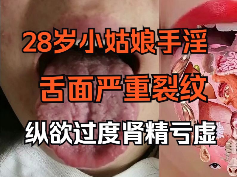 28岁小姑娘欲望大,爱看小电影纵欲过度,导致舌面严重裂纹!哔哩哔哩bilibili