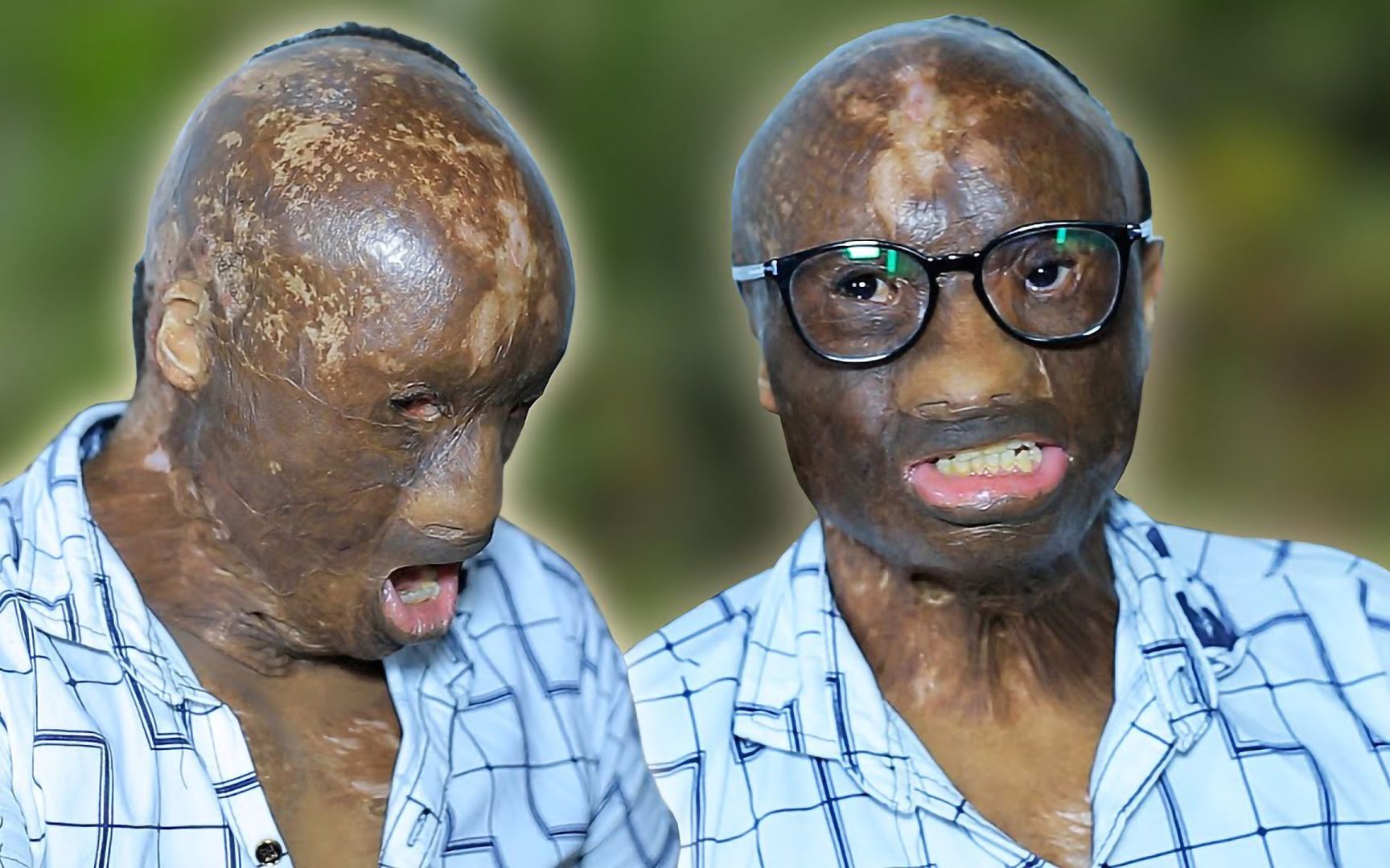 95后小伙被严重烧伤,面部令人毛骨悚然,医生称能活下来是个奇迹