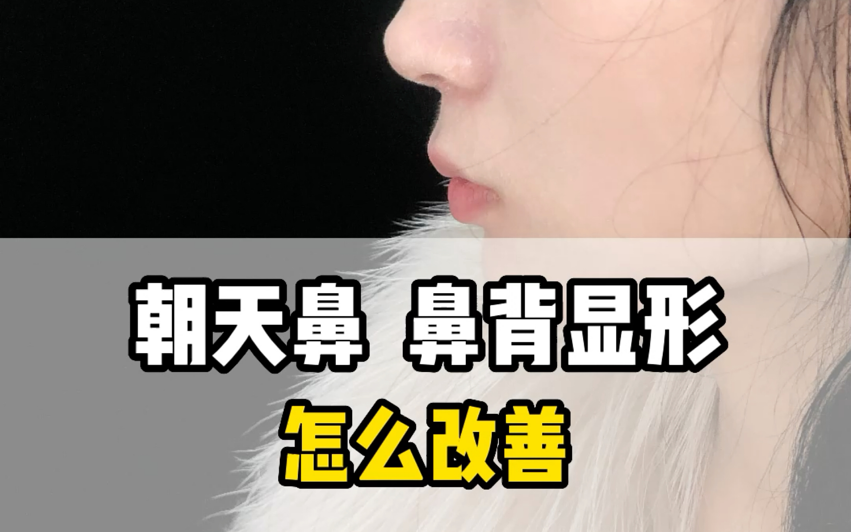 朝天鼻#修复,#假体显形 鼻背棍感,看看调整后20天的效果#变美