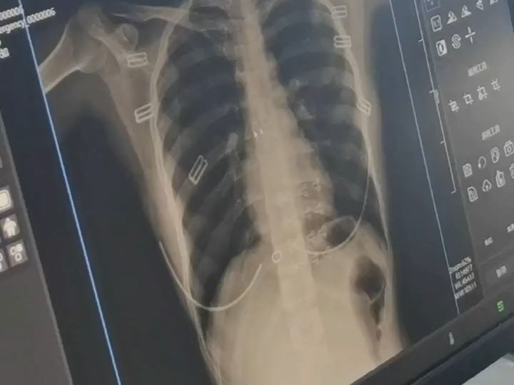 胸片怎么拍 B站