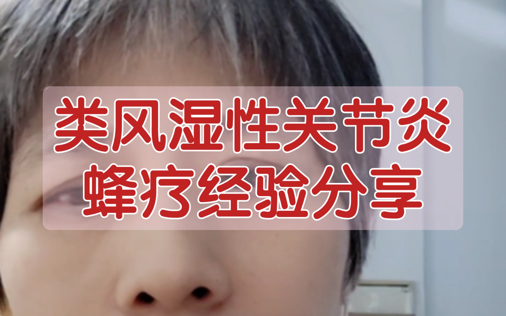 【蜂疗】蜂疗治疗类风湿性关节炎,2022年11月16日,广东省深圳市占春红分享,中国蜂疗交流群哔哩哔哩bilibili