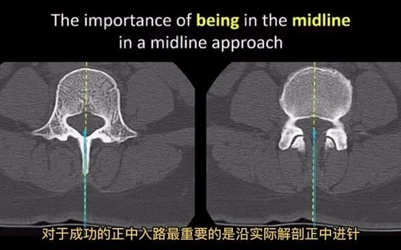 实用技术 椎管内麻醉穿刺技术基础(中文字幕)哔哩哔哩bilibili