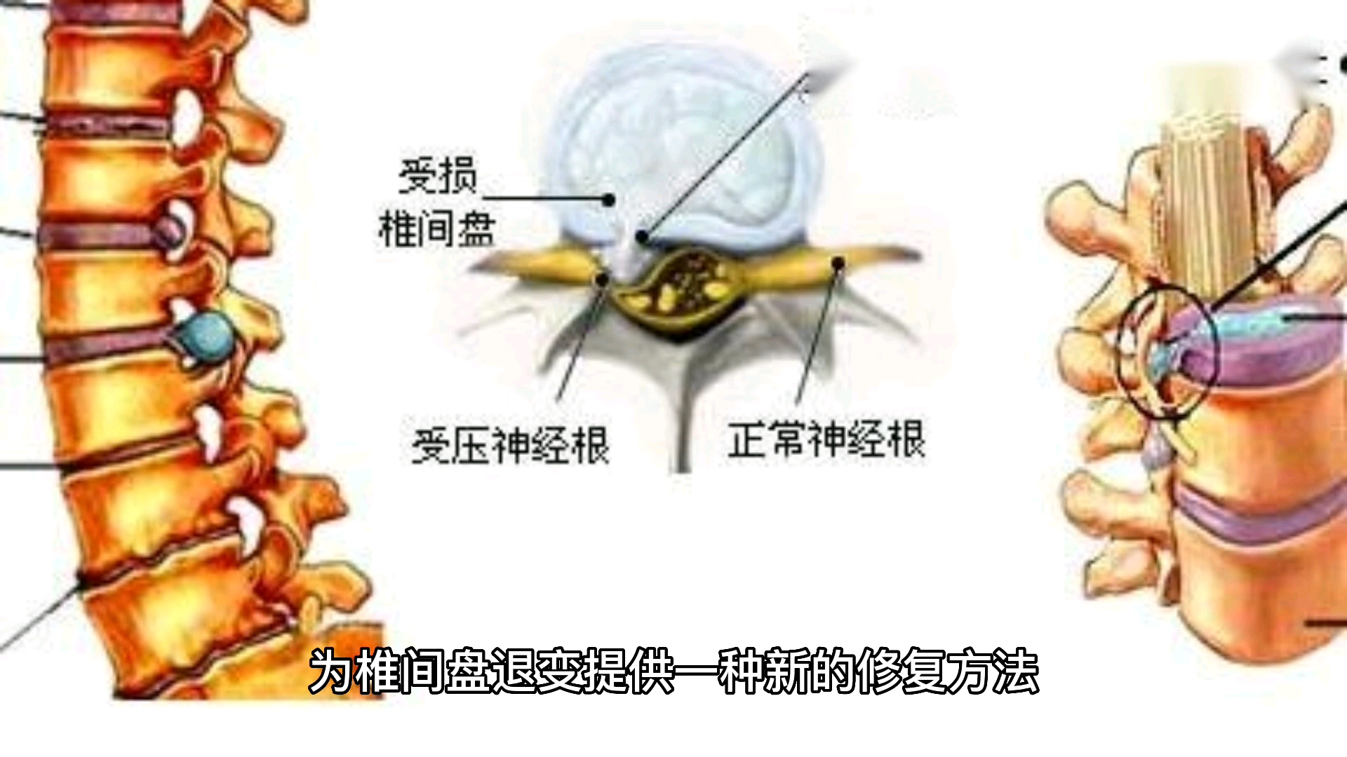 干细胞将成为修复椎间盘退变的新替代疗法.哔哩哔哩bilibili