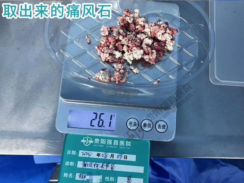 取了痛风石,为什么还要调代谢?——贵阳强直医院