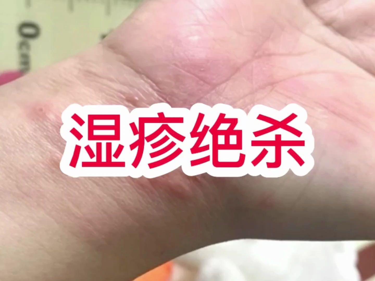 我要哭了,溼疹反覆了那麼久才知道剋星是這