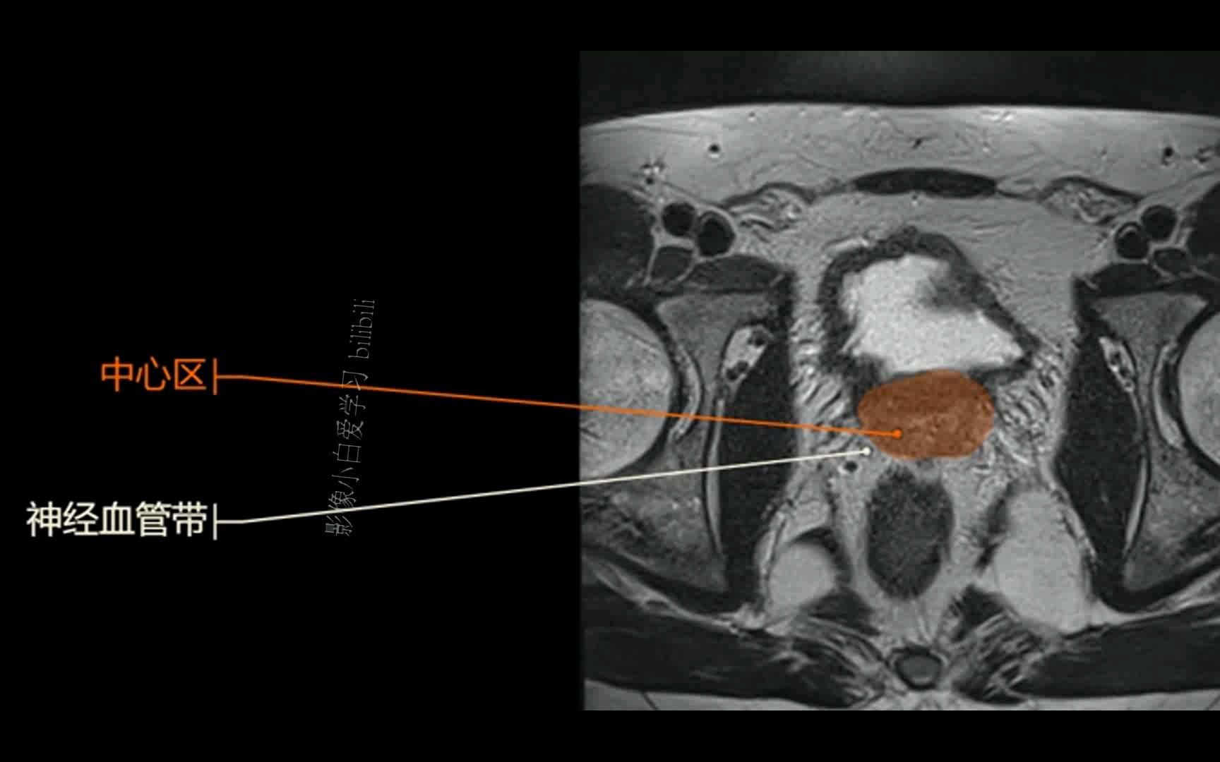 7.盆腔mri解剖圖譜-前列腺解剖帶區mri解剖