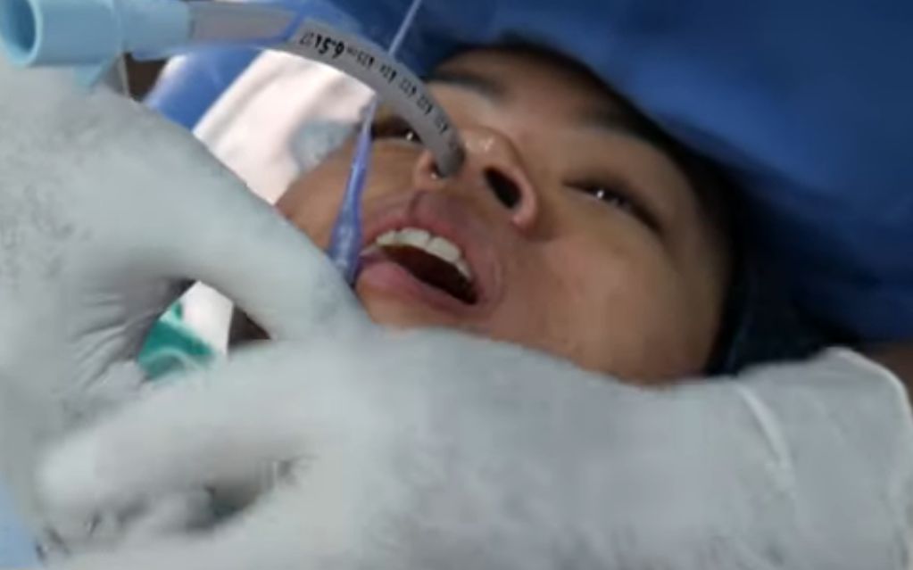 科普向:真实麻醉过程 插鼻管都毫无反应