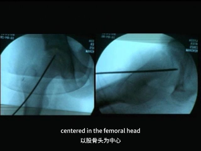 6股骨头骨骺滑脱螺钉内固定术哔哩哔哩bilibili