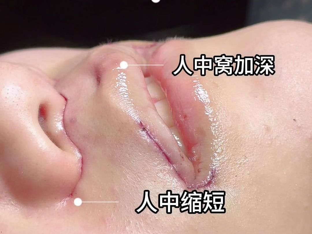 口周攻略|人中和人中窝能同时做吗