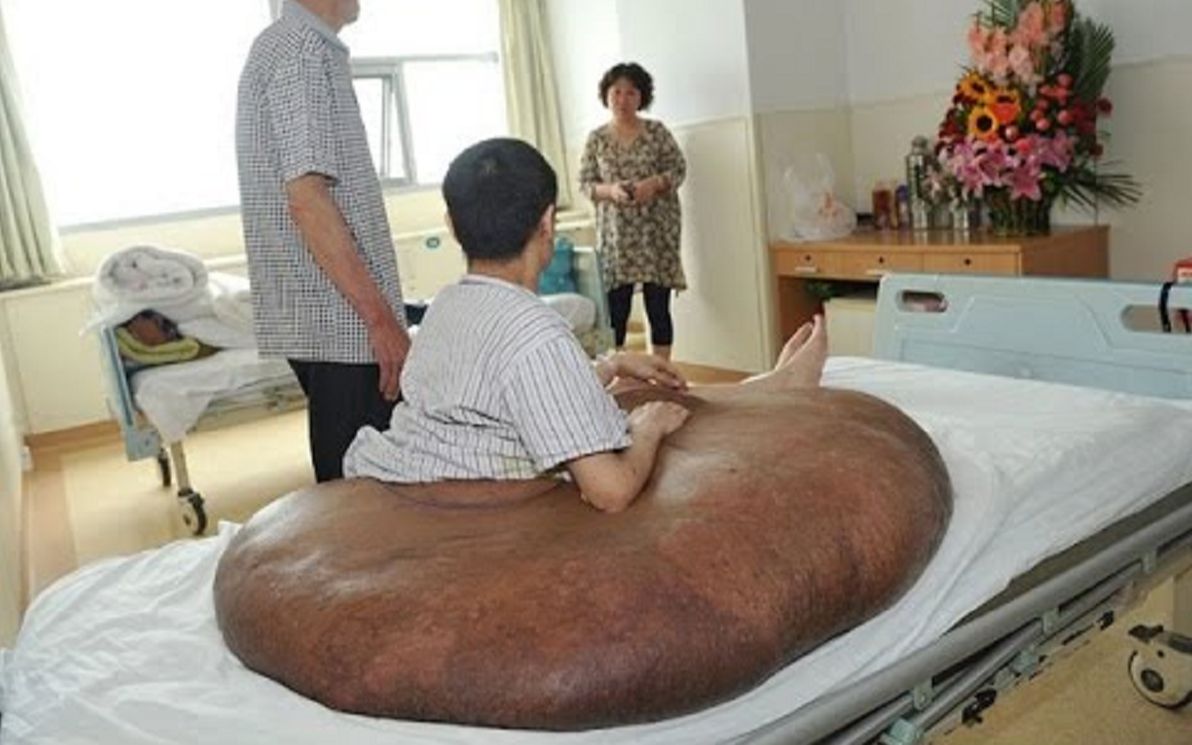 他被世界上最大的肿瘤侵蚀，身体已经变成一滩泥...@油兔不二字幕组
