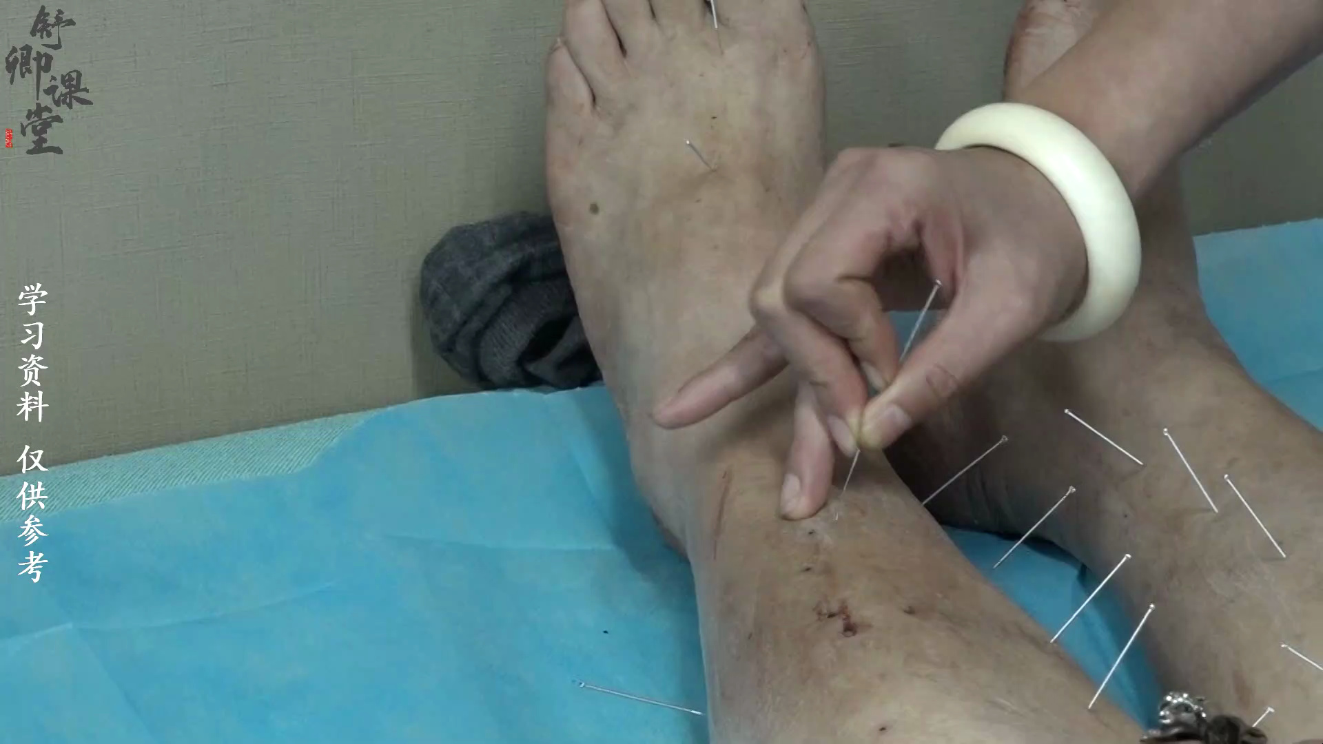 舒氏针灸:舒卿老师现场实操针灸教学,学员的结节很明显的变小了