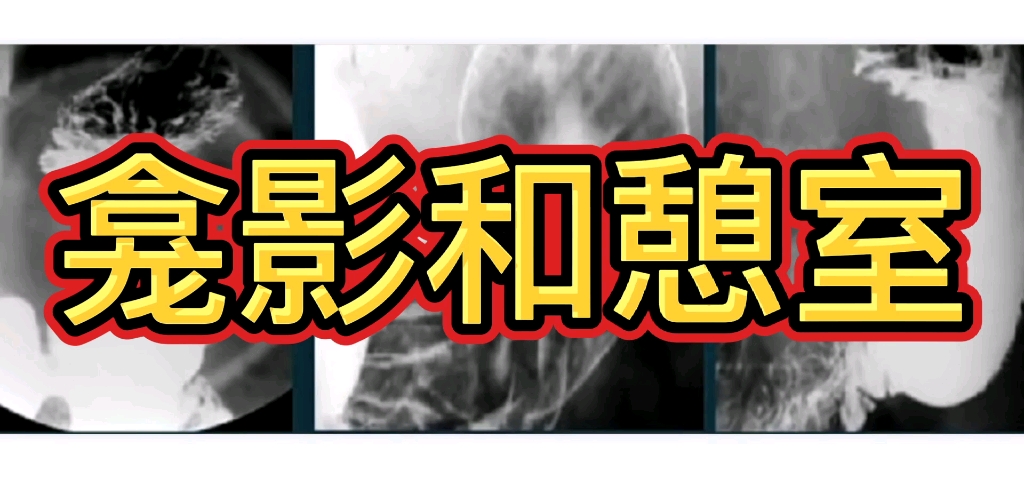 龛影和憩室在X线上分别什么表现?有何区别?医生讲解哔哩哔哩bilibili