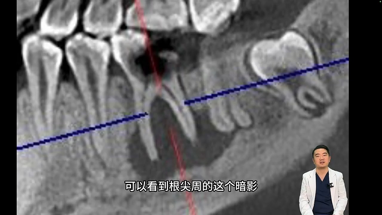 08【第一章】牙拔除后的位点保存术6哔哩哔哩bilibili